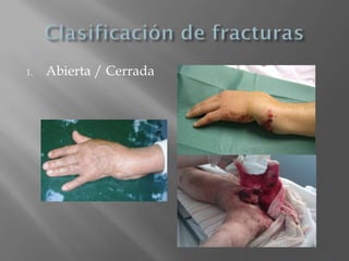 1.   Abierta / Cerrada
 