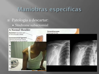    Patología a descartar:
       Síndrome subacromial
       Patología del manguito rotador
       Inestabilidad
 