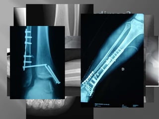    SIEMPRE dos proyecciones: A-P y Lateral
   También oblicua si sospecha de fractura
    articular
   Se deben ver la articulaciones superior e
    inferior a la afectada
   Si duda, pedir placa de miembro contralateral
 