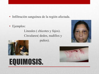 • Infiltración sanguínea de la región afectada.

• Ejemplos:
          Lineales ( chicotes y fajos).
          Circulares( dedos, nudillos y
                      puños).




EQUIMOSIS.
 