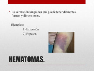 • Es la relación sanguínea que puede tener diferentes
  formas y dimensiones.

 Ejemplos:
         1) Extensión.
         2) Espesor.




HEMATOMAS.
 