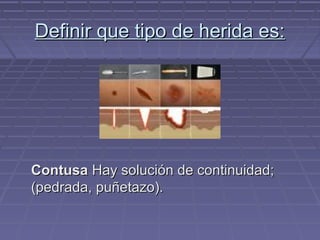 DDeeffiinniirr qquuee ttiippoo ddee hheerriiddaa eess:: 
CCoonnttuussaa HHaayy ssoolluucciióónn ddee ccoonnttiinnuuiiddaadd;; 
((ppeeddrraaddaa,, ppuuññeettaazzoo)).. 
 