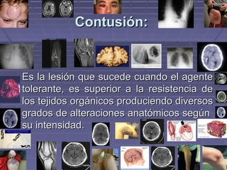 CCoonnttuussiióónn:: 
EEss llaa lleessiióónn qquuee ssuucceeddee ccuuaannddoo eell aaggeennttee 
ttoolleerraannttee,, eess ssuuppeerriioorr aa llaa rreessiisstteenncciiaa ddee 
llooss tteejjiiddooss oorrggáánniiccooss pprroodduucciieennddoo ddiivveerrssooss 
ggrraaddooss ddee aalltteerraacciioonneess aannaattóómmiiccooss sseeggúúnn 
ssuu iinntteennssiiddaadd.. 
 