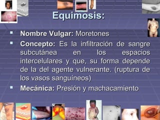 EEqquuiimmoossiiss:: 
 NNoommbbrree VVuullggaarr:: MMoorreettoonneess 
 CCoonncceeppttoo:: EEss llaa iinnffiillttrraacciióónn ddee ssaannggrree 
ssuubbccuuttáánneeaa eenn llooss eessppaacciiooss 
iinntteerrcceelluullaarreess yy qquuee,, ssuu ffoorrmmaa ddeeppeennddee 
ddee llaa ddeell aaggeennttee vvuullnneerraannttee.. ((rruuppttuurraa ddee 
llooss vvaassooss ssaanngguuíínneeooss)) 
 MMeeccáánniiccaa:: PPrreessiióónn yy mmaacchhaaccaammiieennttoo 
 