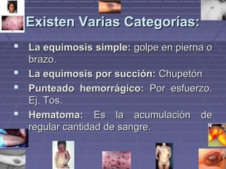 EExxiisstteenn VVaarriiaass CCaatteeggoorrííaass:: 
 LLaa eeqquuiimmoossiiss ssiimmppllee:: ggoollppee eenn ppiieerrnnaa oo 
bbrraazzoo.. 
 LLaa eeqquuiimmoossiiss ppoorr ssuucccciióónn:: CChhuuppeettóónn 
 PPuunntteeaaddoo hheemmoorrrráággiiccoo:: PPoorr eessffuueerrzzoo.. 
EEjj.. TTooss.. 
 HHeemmaattoommaa:: EEss llaa aaccuummuullaacciióónn ddee 
rreegguullaarr ccaannttiiddaadd ddee ssaannggrree.. 
 