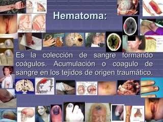 HHeemmaattoommaa:: 
EEss llaa ccoolleecccciióónn ddee ssaannggrree ffoorrmmaannddoo 
ccooáágguullooss.. AAccuummuullaacciióónn oo ccooaagguulloo ddee 
ssaannggrree eenn llooss tteejjiiddooss ddee oorriiggeenn ttrraauummááttiiccoo.. 
 