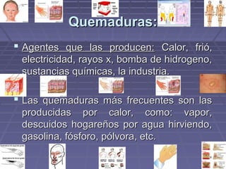 QQuueemmaadduurraass:: 
 AAggeenntteess qquuee llaass pprroodduucceenn:: CCaalloorr,, ffrriióó,, 
eelleeccttrriicciiddaadd,, rraayyooss xx,, bboommbbaa ddee hhiiddrrooggeennoo,, 
ssuussttaanncciiaass qquuíímmiiccaass,, llaa iinndduussttrriiaa.. 
 LLaass qquueemmaadduurraass mmááss ffrreeccuueenntteess ssoonn llaass 
pprroodduucciiddaass ppoorr ccaalloorr,, ccoommoo:: vvaappoorr,, 
ddeessccuuiiddooss hhooggaarreeññooss ppoorr aagguuaa hhiirrvviieennddoo,, 
ggaassoolliinnaa,, ffóóssffoorroo,, ppóóllvvoorraa,, eettcc.. 
 