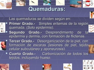 QQuueemmaadduurraass:: 
LLaass qquueemmaadduurraass ssee ddiivviiddeenn sseeggúúnn eenn:: 
 PPrriimmeerr GGrraaddoo..-- SSiimmpplleess eerriitteemmaass ddee llaa rreeggiióónn 
qquueemmaaddaa.. ((SSoolloo eeppiiddeerrmmiiss)).. 
 SSeegguunnddoo GGrraaddoo..-- DDeesspprreennddiimmiieennttoo ddee llaa 
eeppiiddeerrmmiiss yy ddeerrmmiiss,, ccoonn ffoorrmmaacciióónn ddee fflliicctteennaass.. 
 TTeerrcceerr GGrraaddoo..-- DDeessoorrggaanniizzaacciióónn ddee llaa ppiieell,, ccoonn 
ffoorrmmaacciióónn ddee eessccaarraass ((lleessiioonneess ddee ppiieell,, tteejjiiddoo 
cceelluullaarr ssuubbccuuttáánneeoo yy aappoonneeuurroossiiss)).. 
 CCuuaarrttoo GGrraaddoo..-- CCaarrbboonniizzaacciióónn ddee ttooddooss llooss 
tteejjiiddooss,, iinncclluuyyeennddoo hhuueessoo.. 
 