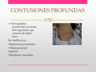  Sonaquellas
producidas en zonas
del organismo que
carecen de tejido
óseo.
Se clasifican en:
•Equimosis profundas.
•Dislocación de
órganos.
•Rupturas viscerales.
CONTUSIONES PROFUNDAS
 
