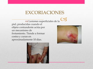 piel, producidas cuando el
objeto contundente actúa por
un mecanismo de
frotamiento. Tiende a formar
costra y curan en
aproximadamente 10 días.
EXCORIACIONES
 Lesiones superficiales de la 
 