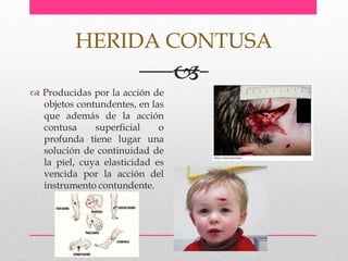  Producidas por la acción de
objetos contundentes, en las
que además de la acción
contusa superficial o
profunda tiene lugar una
solución de continuidad de
la piel, cuya elasticidad es
vencida por la acción del
instrumento contundente.
HERIDA CONTUSA

 