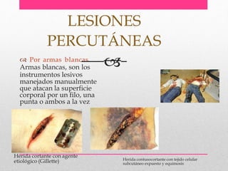  Por armas blancas.
Armas blancas, son los
instrumentos lesivos
manejados manualmente
que atacan la superficie
corporal por un filo, una
punta o ambos a la vez
LESIONES
PERCUTÁNEAS

Herida cortante con agente
etiológico (Gillette) Herida contusocortante con tejido celular
subcutáneo expuesto y equimosis
 
