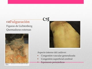 Fulguración
Figuras de Lichtenberg
Quemaduras extensas
Aspecto interno del cadáver:
 Congestión vascular generalizada
 Congestión superficial cerebral
 Equimosis pericárdicas
 
