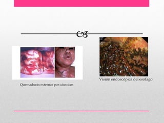 
Visión endoscópica del esófago
Quemaduras externas por cáusticos
 