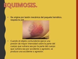 • Se origina por lesión mecánica del paquete hemático,
respeta la piel.
• Cuando el objeto contundente ejerce una
presión de mayor intensidad sobre la parte del
cuerpo que vulnera sea por la parte del cuerpo
que vulnera sea por accidente o agresión, se
produce una accidente o agresión.
 