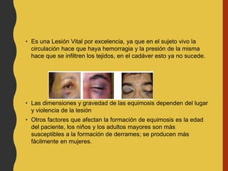 • Es una Lesión Vital por excelencia, ya que en el sujeto vivo la
circulación hace que haya hemorragia y la presión de la misma
hace que se infiltren los tejidos, en el cadáver esto ya no sucede.
• Las dimensiones y gravedad de las equimosis dependen del lugar
y violencia de la lesión
• Otros factores que afectan la formación de equimosis es la edad
del paciente, los niños y los adultos mayores son más
susceptibles a la formación de derrames; se producen más
fácilmente en mujeres.
 