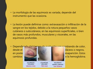 • La morfología de las equimosis es variada, depende del
instrumento que las ocasiona.
• La lesión puede definirse como: extravasación o infiltración de la
sangre en los tejidos, debido a la rotura pequeños vasos
cutáneos o subcutáneos, en las equimosis superficiales, o bien
de vasos más profundos, musculares y viscerales, en las
equimosis profundas.
• Dependiendo del tiempo de evolución van cambiando de color,
desde el rojo oscuro de los primeros días a violáceos o negros,
en posteriores, o verdes y amarillos hacia su desaparición. Estos
cambios de color se deben a la degradación de la hemoglobina.
 