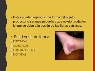 • Estas pueden reproducir la forma del objeto
productor o ser más pequeñas que objeto productor
lo que se debe a la acción de las fibras elásticas.
• Pueden ser de forma:
REDONDAS
ALARGADAS
CUADRANGULARES
DIGITADAS
 