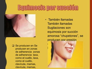 • También llamadas
También llamadas
Sugilaciones son
equimosis por succión
amorosa “chupetones”, se
producen por presión
negativa labial o
labiodental sobre la piel.
 Se producen en Se
producen en zonas
de adherencia zonas
de adherencia laxa,
como el cuello, laxa,
como el cuello,
clavícula, mamas,
clavícula, mamas,
 