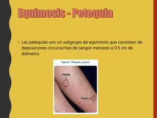 • Las petequias son un subgrupo de equimosis que consisten de
deposiciones circunscritas de sangre menores a 0.5 cm de
diámetro.
 