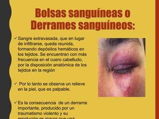 Bolsas sanguíneas o
Derrames sanguíneos:
Sangre extravasada, que en lugar
de infiltrarse, queda reunida,
formando depósitos hemáticos en
los tejidos. Se encuentran con más
frecuencia en el cuero cabelludo,
por la disposición anatómica de los
tejidos en la región
 Por lo tanto se observa un relieve
en la piel, que es palpable.
Es la consecuencia de un derrame
importante, producido por un
traumatismo violento y su
 