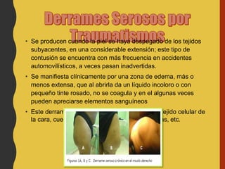 • Se producen cuando la piel se haya despegado de los tejidos
subyacentes, en una considerable extensión; este tipo de
contusión se encuentra con más frecuencia en accidentes
automovilísticos, a veces pasan inadvertidas.
• Se manifiesta clínicamente por una zona de edema, más o
menos extensa, que al abrirla da un líquido incoloro o con
pequeño tinte rosado, no se coagula y en el algunas veces
pueden apreciarse elementos sanguíneos
• Este derrame seroso se puede encontrar en el tejido celular de
la cara, cuello o región lumbar, paredes torácicas, etc.
 