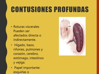 CONTUSIONES PROFUNDAS
• Roturas viscerales
Pueden ser
afectados directa o
indirectamente.
• Hígado, bazo,
riñones, pulmones y
corazón, cerebro,
estómago, intestinos
y vejiga.
• Papel importante:
esquirlas o
 