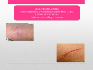 LESIONES RECIENTES
Aun no cicatrizadas y/o no resueltas dentro de los 10 dias.
LESIONES ANTIGUAS
Lesiones cicatrizadas y/o resueltas
 