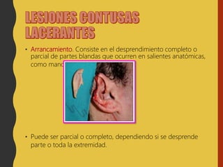 • Arrancamiento. Consiste en el desprendimiento completo o
parcial de partes blandas que ocurren en salientes anatómicas,
como manos, piernas, orejas o pene.
• Puede ser parcial o completo, dependiendo si se desprende
parte o toda la extremidad.
 