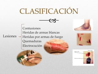 CLASIFICACIÓN

Lesiones
Contusiones
Heridas de armas blancas
Heridas por armas de fuego
Quemaduras
Electrocución
 