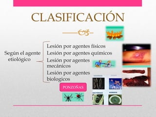 Lesión por agentes físicos
Lesión por agentes químicos
Lesión por agentes
mecánicos
Lesión por agentes
biologicos
CLASIFICACIÓN

Según el agente
etiológico
PONZOÑAS
 
