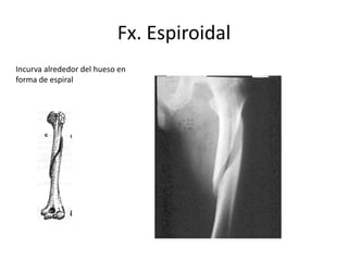 Fx. Espiroidal
Incurva alrededor del hueso en
forma de espiral
 