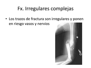 Fx. Irregulares complejas
• Los trazos de fractura son irregulares y ponen
en riesgo vasos y nervios
 