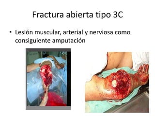 Fractura abierta tipo 3C
• Lesión muscular, arterial y nerviosa como
consiguiente amputación
 