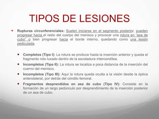 TIPOS DE LESIONES
 Rupturas circunferenciales: Suelen iniciarse en el segmento posterior, pueden
progresar hacia el resto del cuerpo del menisco y provocar una rotura en “asa de
cubo” o bien progresar hacia el borde interno, quedando como una lesión
pediculada.
 Completos (Tipo I): La rotura se produce hasta la inserción anterior y queda el
fragmento roto luxado dentro de la escotadura intercondílea.
 Incompletos (Tipo II): La rotura se localiza a poca distancia de la inserción del
cuerno del menisco.
 Incompletos (Tipo III): Aquí la rotura queda oculta a la visión desde la óptica
anterolateral, por detrás del cóndilo femoral.
 Fragmentos desprendidos en asa de cubo (Tipo IV): Consiste en la
formación de un largo pedúnculo por desprendimiento de la inserción posterior
de un asa de cubo.
 