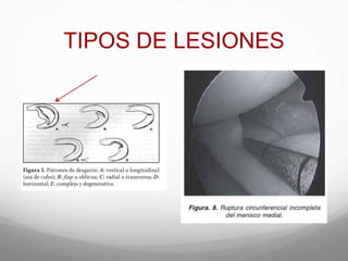 TIPOS DE LESIONES
 