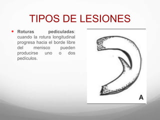 TIPOS DE LESIONES
 Roturas pediculadas:
cuando la rotura longitudinal
progresa hacia el borde libre
del menisco pueden
producirse uno o dos
pedículos.
 
