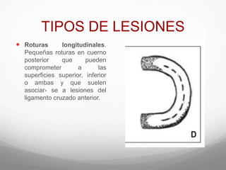 TIPOS DE LESIONES
 Roturas longitudinales.
Pequeñas roturas en cuerno
posterior que pueden
comprometer a las
superficies superior, inferior
o ambas y que suelen
asociar- se a lesiones del
ligamento cruzado anterior.
 