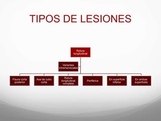 TIPOS DE LESIONES
Rotura
longitudinal
Fisura corta
posterior
Asa de cubo
corta
Rotura
longitudinal
completa
Periférica
En superficie
inferior
En ambas
superficies
Variantes
intrameniscales
 