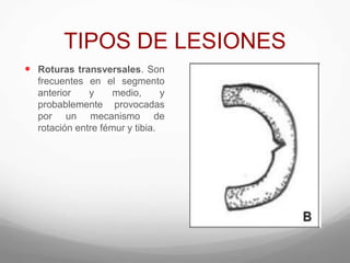 TIPOS DE LESIONES
 Roturas transversales. Son
frecuentes en el segmento
anterior y medio, y
probablemente provocadas
por un mecanismo de
rotación entre fémur y tibia.
 