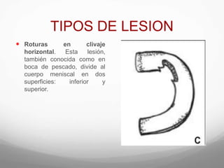 TIPOS DE LESION
 Roturas en clivaje
horizontal. Esta lesión,
también conocida como en
boca de pescado, divide al
cuerpo meniscal en dos
superficies: inferior y
superior.
 