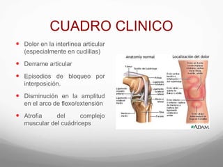 CUADRO CLINICO
 Dolor en la interlinea articular
(especialmente en cuclillas)
 Derrame articular
 Episodios de bloqueo por
interposición.
 Disminución en la amplitud
en el arco de flexo/extensión
 Atrofia del complejo
muscular del cuádriceps
 