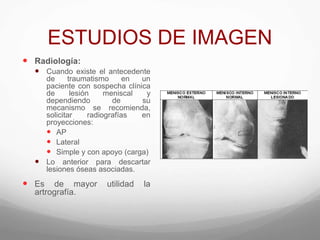 ESTUDIOS DE IMAGEN
 Radiología:
 Cuando existe el antecedente
de traumatismo en un
paciente con sospecha clínica
de lesión meniscal y
dependiendo de su
mecanismo se recomienda,
solicitar radiografías en
proyecciones:
 AP
 Lateral
 Simple y con apoyo (carga)
 Lo anterior para descartar
lesiones óseas asociadas.
 Es de mayor utilidad la
artrografía.
 