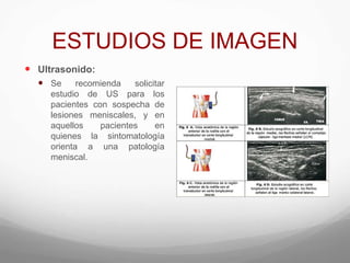 ESTUDIOS DE IMAGEN
 Ultrasonido:
 Se recomienda solicitar
estudio de US para los
pacientes con sospecha de
lesiones meniscales, y en
aquellos pacientes en
quienes la sintomatología
orienta a una patología
meniscal.
 