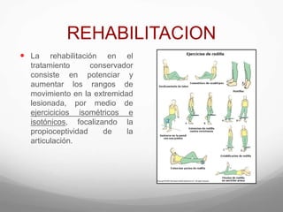 REHABILITACION
 La rehabilitación en el
tratamiento conservador
consiste en potenciar y
aumentar los rangos de
movimiento en la extremidad
lesionada, por medio de
ejercicicios isométricos e
isotónicos, focalizando la
propioceptividad de la
articulación.
 