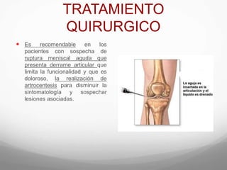 TRATAMIENTO
QUIRURGICO
 Es recomendable en los
pacientes con sospecha de
ruptura meniscal aguda que
presenta derrame articular que
limita la funcionalidad y que es
doloroso, la realización de
artrocentesis para disminuir la
sintomatología y sospechar
lesiones asociadas.
 