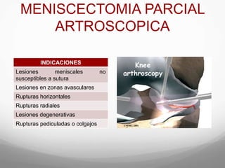 MENISCECTOMIA PARCIAL
ARTROSCOPICA
INDICACIONES
Lesiones meniscales no
susceptibles a sutura
Lesiones en zonas avasculares
Rupturas horizontales
Rupturas radiales
Lesiones degenerativas
Rupturas pediculadas o colgajos
 