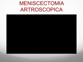 MENISCECTOMIA
ARTROSCOPICA
 