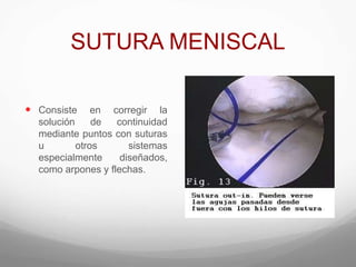 SUTURA MENISCAL
 Consiste en corregir la
solución de continuidad
mediante puntos con suturas
u otros sistemas
especialmente diseñados,
como arpones y flechas.
 