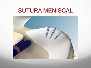 SUTURA MENISCAL
 